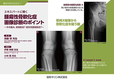 「エキスパートに聴く　腫瘍性骨軟化症 画像診断のポイント ～その痛み、骨粗鬆症？ 変形性膝関節症？～」公開 のサムネイル画像