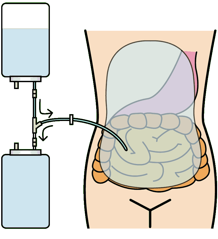 腹膜透析２