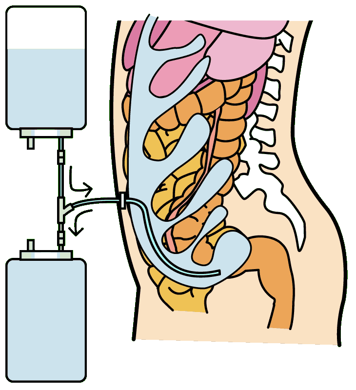 腹膜透析３